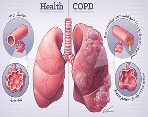 High COPD Risk in Rural Areas